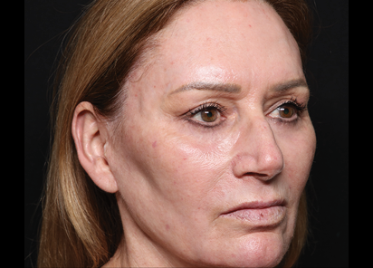 Exion Desktop BA Cards ClearRF AFTER CLEAR RF