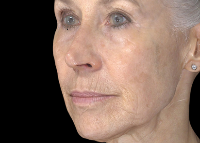 Exion PIC Ba card cheek female 100 Clear RF ENUS100 AFTER Clear RF 