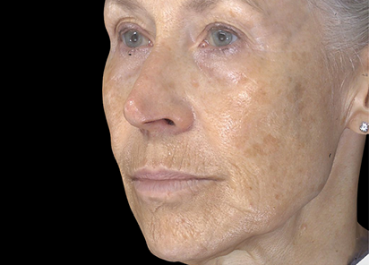 Exion PIC Ba card cheek female 100 Clear RF ENUS100 BEFORE Clear RF 