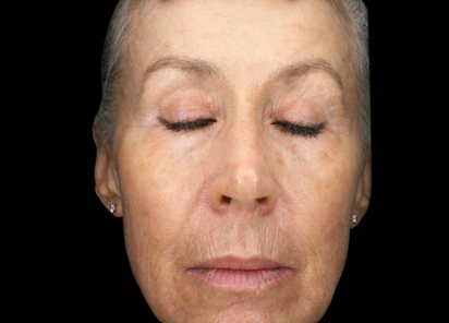 Exion PIC Ba card face female 101 Clear RF ENUS100 AFTER Clear RF