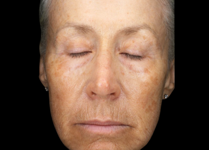 Exion PIC Ba card face female 101 Clear RF ENUS100 BEFORE Clear RF