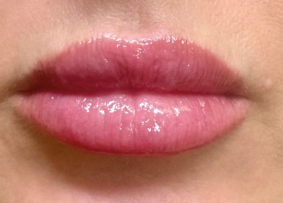 Exion PIC Ba card mouth female 009 Face ENUS100 AFTER Exion Face