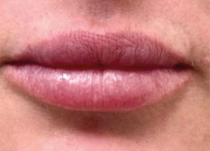 Exion PIC Ba card mouth female 009 Face ENUS100 BEFORE Exion Face