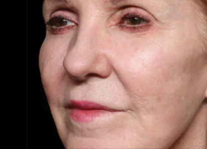 Exion Desktop BA Cards FractionalRF AFTER Fractional RF