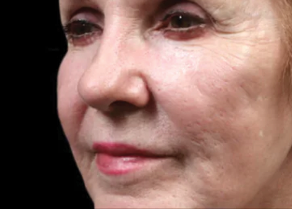 Exion Desktop BA Cards FractionalRF BEFORE Fractional RF