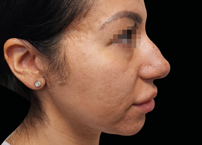 Exion PIC Ba card face female 071 FRF ENUS100 AFTER Fractional RF