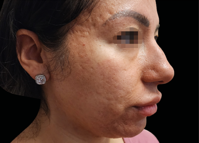 Exion PIC Ba card face female 071 FRF ENUS100 BEFORE Fractional RF