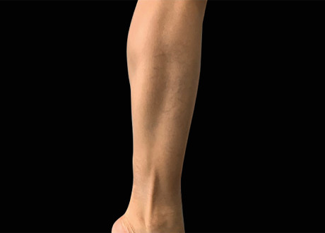 Female Calves 2 After Raminder Saluja MD