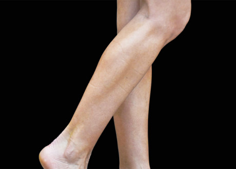 Female Calves After Raminder Saluja MD