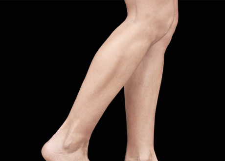 Female Calves Before Raminder Saluja MD