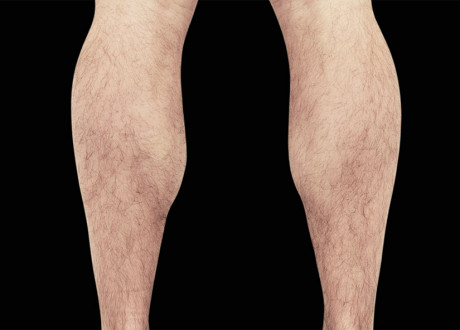 Male Calves 2 After Raminder Saluja MD