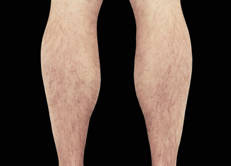 Male Calves 2 Before Raminder Saluja MD