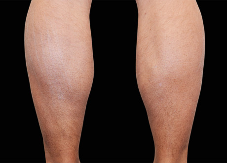 Male Calves After Raminder Saluja MD