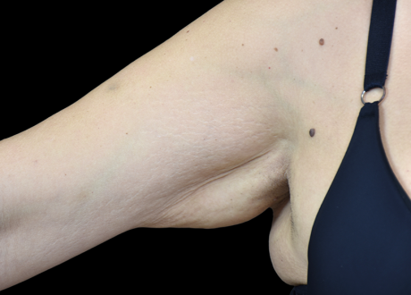 Emtone PIC 005 Before arm female BTL Aesthetics 825x592