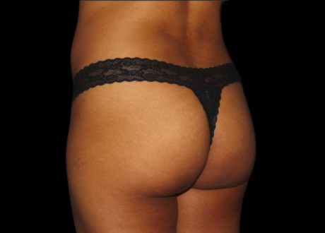 BTL Emsculpt PIC 036 after female Cris Bailey MD 4TX 2 ems