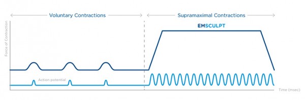 emsculpt contractions