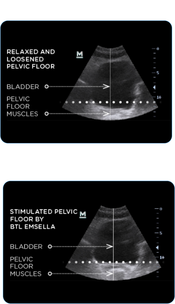 EMSELLA Before and After scan