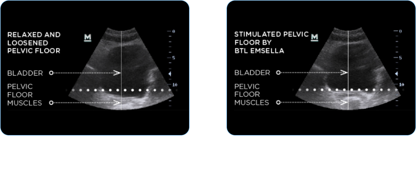 Emsella Before and After scan